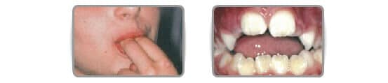 Digital suction (thumb or other finger) (its interruption at the time when the permanent incisors erupt allows a spontaneous correction of the gap and the deformation of the dental arch).