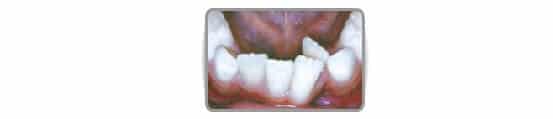 Major dental overlaps (unsightly, increased carious and gingival risk).