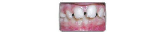 Spaces between incisors greater than 3mm (prevents eruption of canines).
